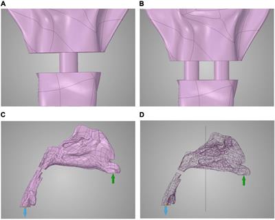 Inspiration After Posterior Pharyngeal Flap Palatoplasty: A Preliminary Study Using Computational Fluid Dynamic Analysis